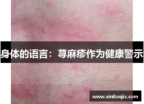 身体的语言：荨麻疹作为健康警示